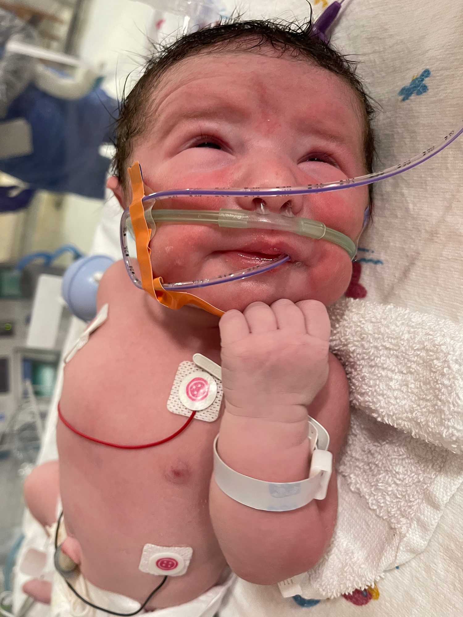 baby with diaphragmatic herniation lays with wires on him