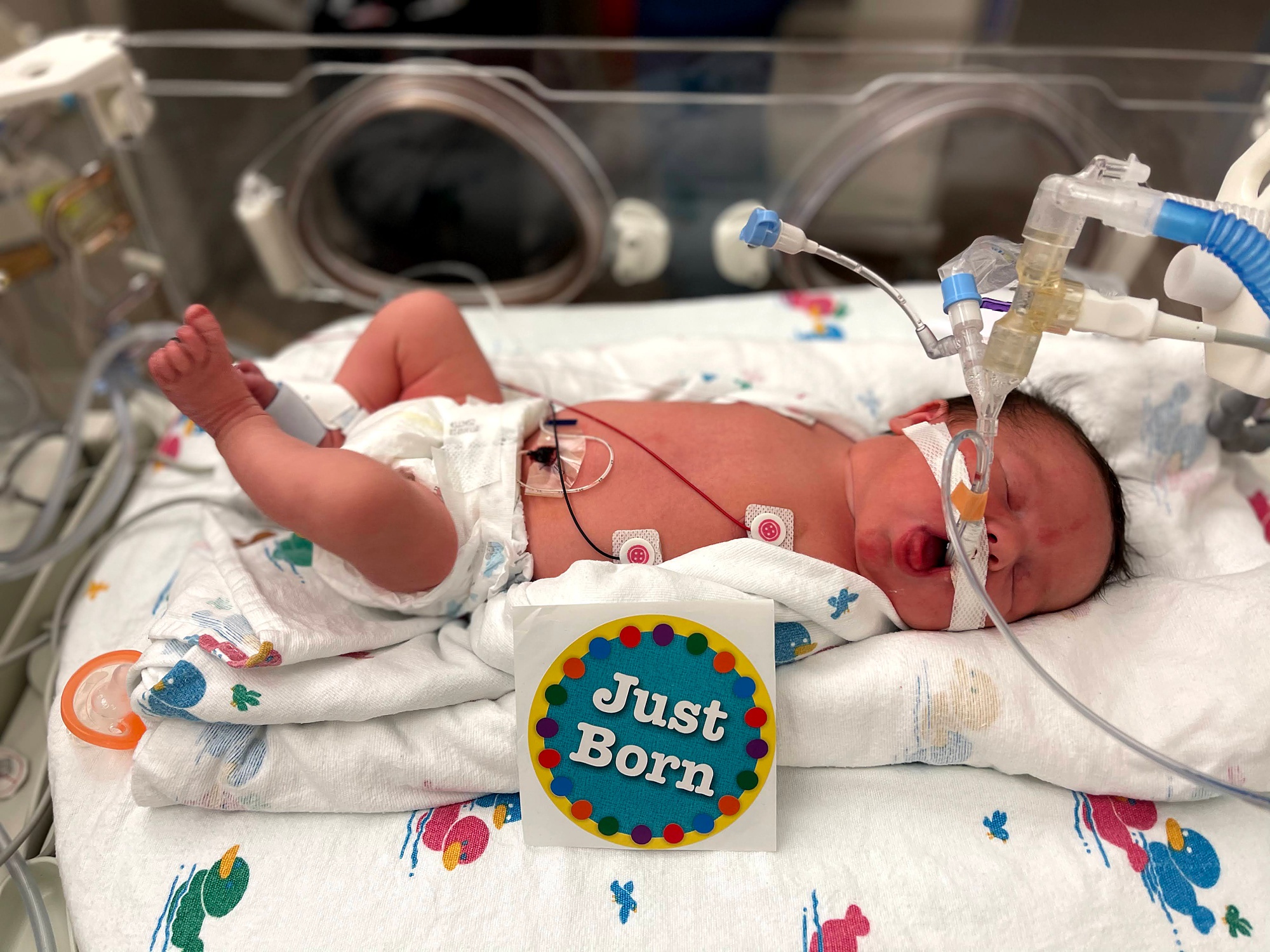 baby lays in hospital after birth with diaphragmatic herniation